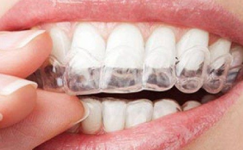 Invisalign Vs Traditional Braces: Which Is Right For You?